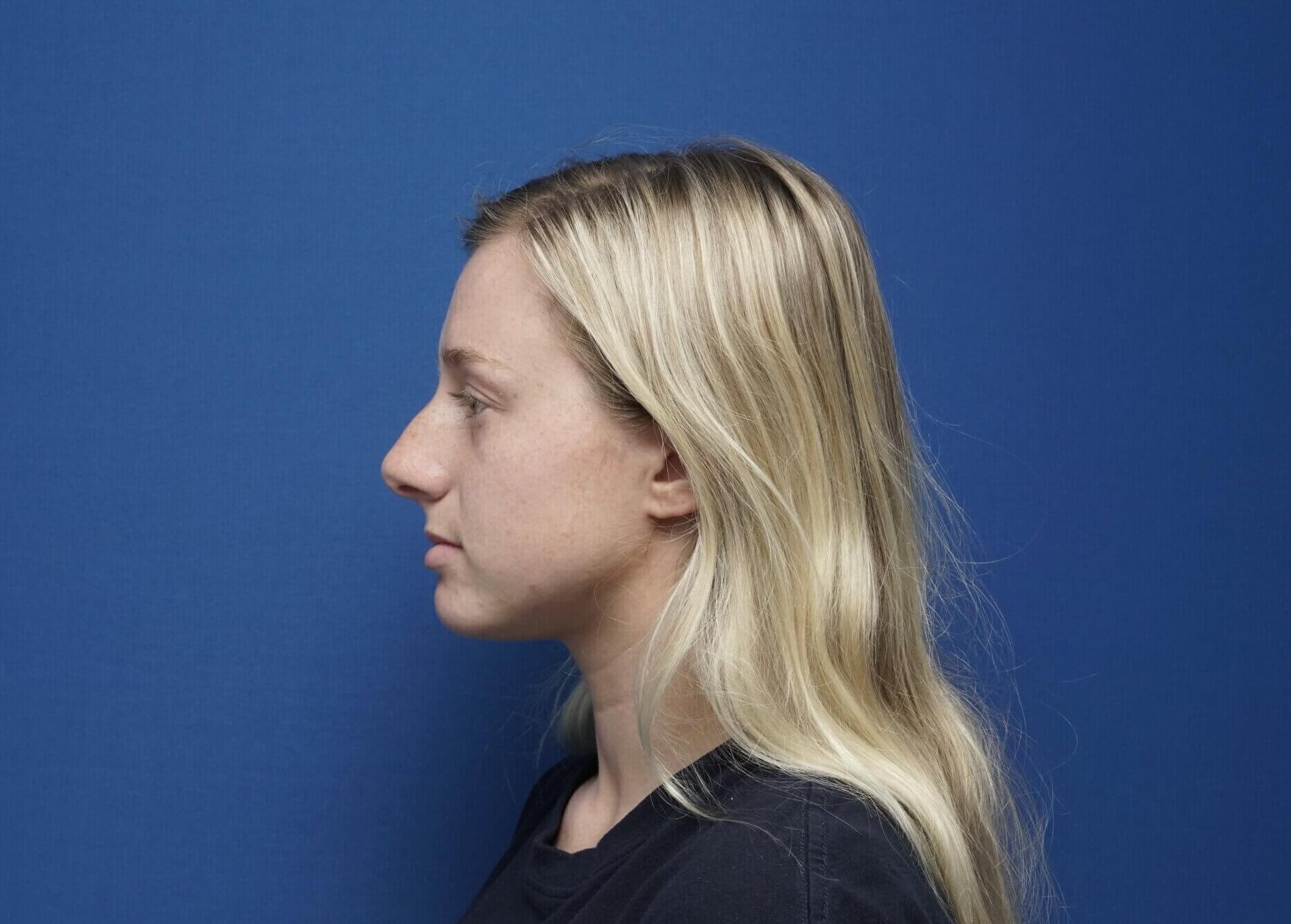 Before and After Rhinoplasty