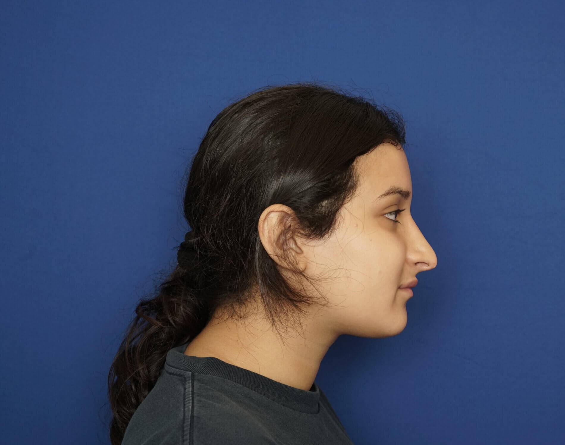 Before and After Rhinoplasty